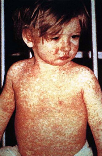 Measles, mumps and rubella vaccine